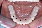 Fig 11. Intraoral view of finished metal–zirconia implant-supported prosthesis.