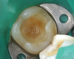Fig 3. Deep cavity preparation showing what is most likely caries-affected dentin remaining. The preparation is cleaned and disinfected with a pumice/2% chlorhexidine mixture, rinsed, and briefly air-dried.