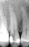 Fig 7. Radiograph of tooth No. 4 taken at presentation showing extensive decay.
