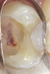 Fig 8. A vital pulp exposure that occurred during caries excavation.