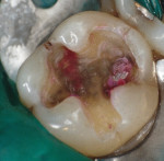Fig 2. Tooth shown in Fig 1 after thorough rinsing and drying. Theoretically, only the caries-infected dentin picks up the stain.