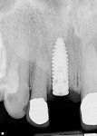 Figure 3  Radiograph of immediately placed implant following extraction of tooth No. 8.