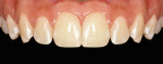 Fig 1. Retracted intraoral image of maxillary arch.