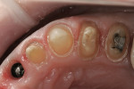 Figure 9: Healthy tissue is evident immediately after removal of the temporaries (note the consistency and color of gingiva circumferentially around the preparations).