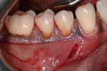 Fig 2. A lateral access was used to create a modified tunnel preparation, achieve flap mobility, and not disturb the areas of gingival pigmentation.