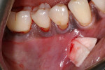 Fig 3. A double layer of an ADM being placed into the mucogingival tunnel.