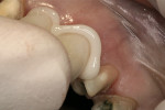 Figure 10  Seating of zirconia restorations with self-adhesive resin cement.
