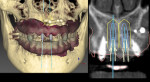 Fig 1. Screenshot of the final superimposition of CBCT scan (DICOM) and optical surface scan (STL) files. The STL file was produced by IOS scanner and imported with live colors into the implant planning software.