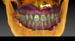 Fig 4. Automated design of the missing teeth with the proper functional and esthetic shape, and placement of them in occlusion with the teeth in opposing arch.