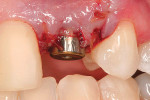 Figure 5  The patient returned from the oral surgeon with the healing abutment tightened.