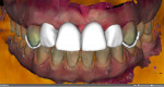 Fig 8. Based on the final tooth shape, as determined by the dental technician or the restorative doctor, the STL file of the interim restoration is imported back into the surgical planning software for a final inspection.