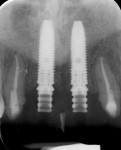 Fig 13. Radiograph verifying the correct prosthetically driven implant position.