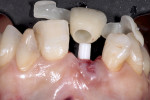 Fig 16. The temporary shell is fitted onto the abutment connected to the implant that was just placed.