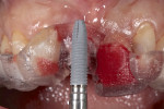 Fig 14. Guided surgery to place an implant to restore upper right central incisor.