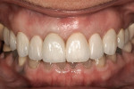 Figure 12  The 6-week postoperative retracted view of tissue health around the zirconia and implant restorations.