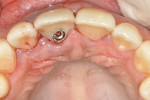 Fig 4. Crown of extracted tooth with immediate placement of the CM pillar after implant insertion.