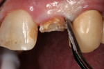 Figure 1  Initiating extraction with a lexit (CK Dental, <a href=