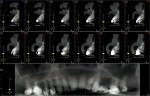 Figure 2  Cone beam analysis of tooth No. 10 prior to extraction.