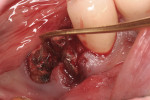 Figure 4  Insertion of a periotome (PST Dental, <a href=