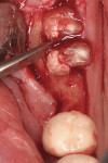 Figure 5  Removal of individual roots with luxators (PST Dental), avoiding pressure on the buccal plate.