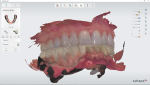 Fig 2. The dentist utilizes an intraoral scanner to capture a digital impression.