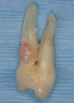 Figure 8  Mesial view of extracted tooth and roots showing thin, twisted roots removed without fracture.