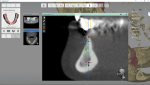 Fig 7. It’s critical to the planning process to have all the pertinent scans and dicom files converge into one usable rendering to virtually place implants.