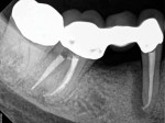 Immediate postoperative radiograph following endodontic treatment performed on the tooth in two visits, utilizing intra-appointment, intracanal calcium hydroxide. The symptoms involving periodontal probing depth and sinus tract resolved following treatment.