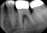 Two years after the initial findings were noted,
clinical and radiographic findings indicated significant and rapid progression of the primary perio lesion into a true combined lesion.