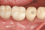 Figure 16  Occlusal view showing the final restorations, hard and soft tissue preservation and augmentation.