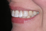 Preoperative smile (left view).