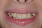 Posttreatment smile, retracted smile view, and retracted maxillary incisal view.