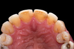 Preoperative incisal view.