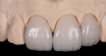 Layering back incisal third with porcelain. Incisal frame and internal stain stage of skeleton build-up technique.