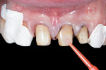 Application of tooth primer.