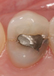 Figure 3  Pulpal floor cracking (as in this asymptomatic tooth) would have changed the treatment plan and the prognosis.