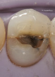 Figure 4  Pulpal floor cracking (as in this asymptomatic tooth) would have changed the treatment plan and the prognosis.