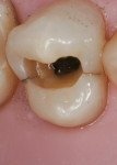 Figure 8  Cracks extended down the proximal walls of the tooth but did not extend onto the pulpal floor.
