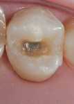 Figure 12  Ribbond THM 4 mm was prepared and the resultant Ribbond/Supreme fiber was placed on the tooth and adapted closely to the dentin without suffering pullback.