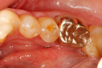 Fig 6. Example of dental erosion that would be categorized as BEWE2. Note that dentin is showing on less than 50% of the occlusal surface.