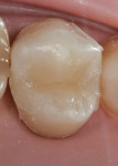 Figure 14  After fiber placement, successive layers of Filtek™ Supreme Ultra Universal Restorative were placed and sculpted.