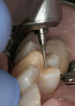 Figure 16  A super-fine interproximal diamond was used to refine the shape sculpted into the occlusal surface.