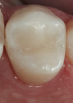 Figure  19  The Filtek™ Supreme Ultra Universal Restorative polished easily to an enamel-like luster and blended nicely with the adjacent tooth structure.