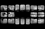 Fig 1. Full-mouth radiographs from the patient’s initial visit in 2005 showed deep caries at No. 16 and periodontal defect at No. 17.
