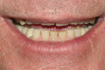 Fig 6. Close-up preoperative view revealed the extent of mandibular tissue display in the patient’s full smile.