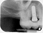 Fig 7. After implant placement, a temporary bridge was placed to wear during the integration phase.