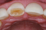 Fig 10. Shiny sclerotic dentin surface beneath the fractured veneer.