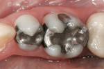 Figure 1  Preoperative view of teeth Nos. 29 and 30.