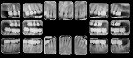 Fig 11. Full-mouth radiographs taken in 2017 showed no periodontal or biomechanical breakdown.