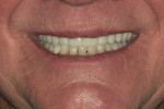 Fig 13. Close-up view of patient’s smile almost 10 years postoperatively showed no wear or chipping.